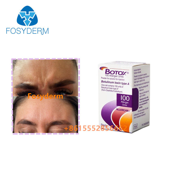 Remove Wrinkles Injection Allergan Botulinum Toxin Type A 100units